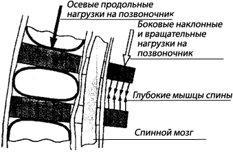 Схема мышечной блокады межпозвонкового диска