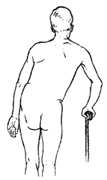 Вынужденная поза больного при сколиозе