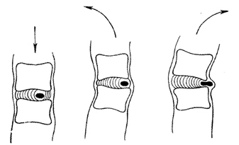 ущемление позвонков